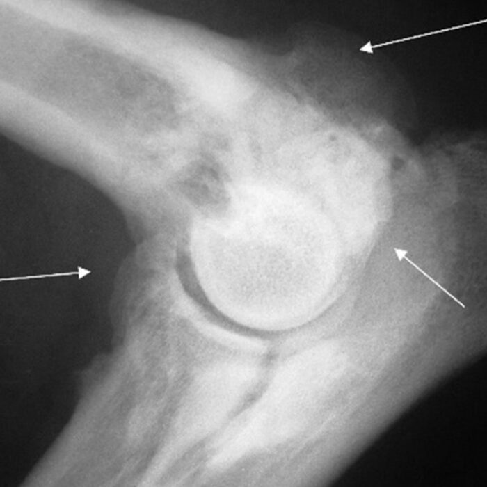Elbow dysplasia