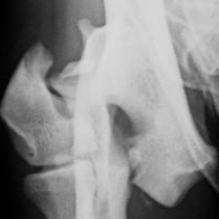Humeral Condylar Fractures
