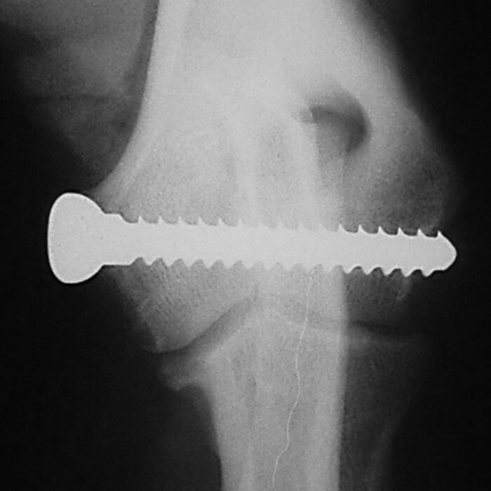Humeral Intracondylar Fissure