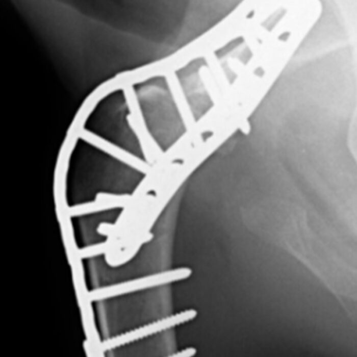Arthrodesis